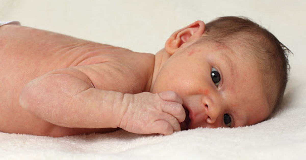 Kuru Bebek Cildi Nedenleri, Belirtileri ve Ev Çözümleri Kuru Bebek Cildi Nedenleri, Belirtileri ve Ev Çözümleri