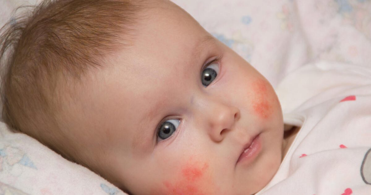 İnek Sütü Protein Alerjisi Nedir, Tedavisi Nasıl Yapılır